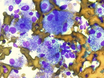 Histoplasmosis 12