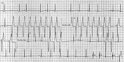 ECG5 TerriDeF 5