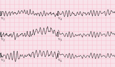 Ventricular fibrillation 2