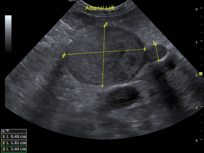 Adrenal Ultrasound 2