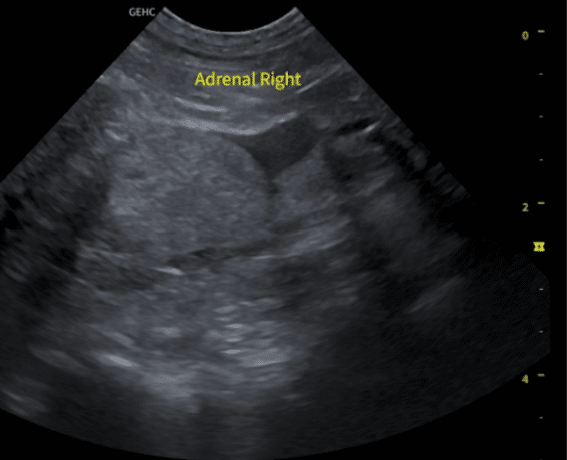 Adrenal Ultrasound 3