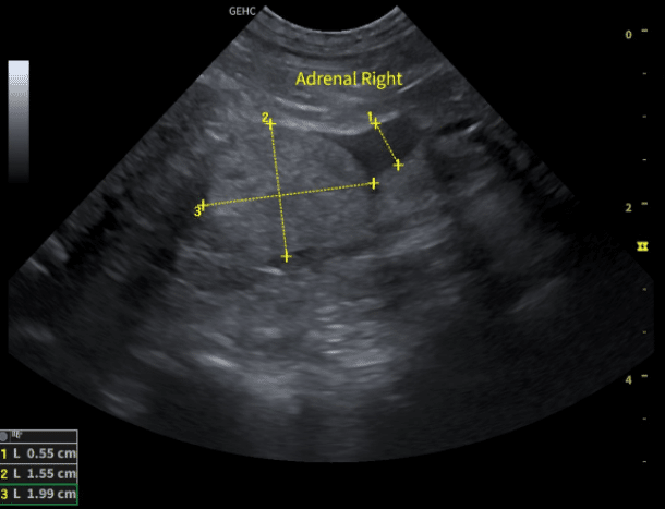Adrenal Ultrasound 4